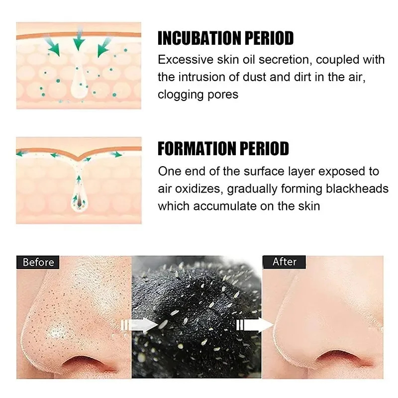 10/150PCS Blackhead Remove Mas - Skincare Finally Found You review and price